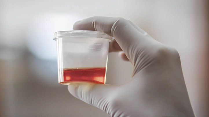 Blood Clots In Urine